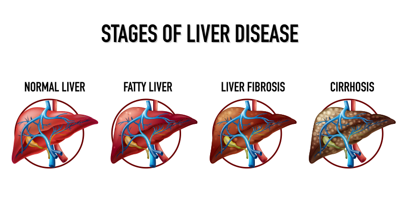 Fatty liver stages
